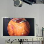 Intervenție laparoscopică de înaltă precizie realizată cu succes la SCJU Sibiu: Hemicolectomie dreaptă efectuată unui pacient oncologic în vârstă de 80 de ani