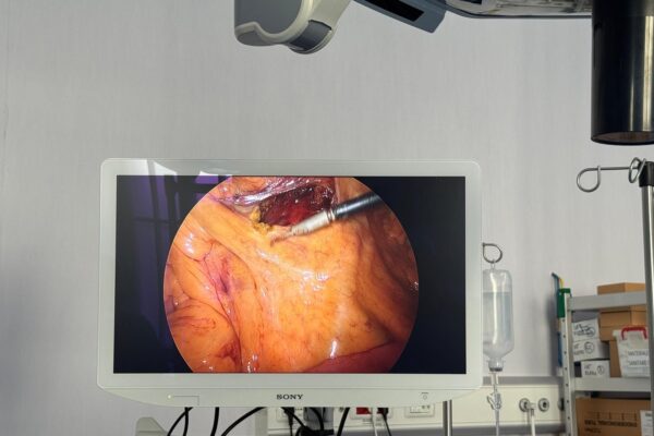Intervenție laparoscopică de înaltă precizie realizată cu succes la SCJU Sibiu: Hemicolectomie dreaptă efectuată unui pacient oncologic în vârstă de 80 de ani