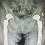 Premieră medicală în județul Sibiu: artroplastie bilaterală de șold realizată într-un singur timp operator, la SCJUS