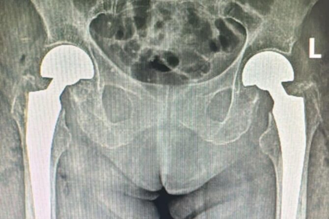 Premieră medicală în județul Sibiu: artroplastie bilaterală de șold realizată într-un singur timp operator, la SCJUS